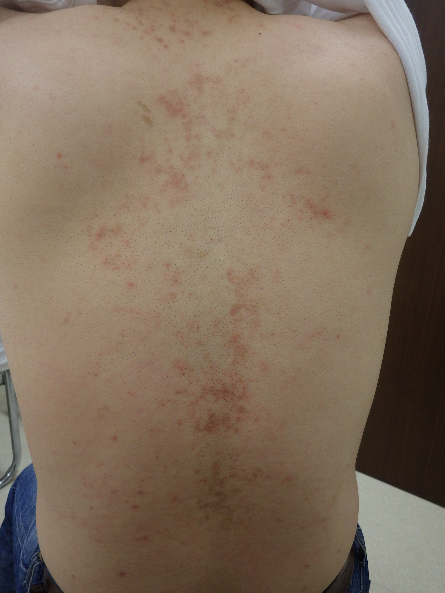 帯状疱疹(たいじょうほうしん）について | 静岡市駿河区の『 いのうえ皮ふ科（井上皮膚科）』