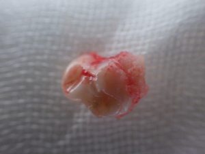 摘出された粉瘤（アテローム）の被膜