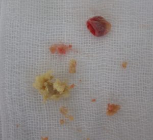 粉瘤（アテローム）摘出　左下内容物、右上被膜