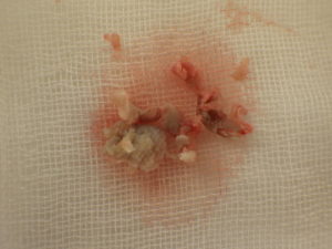 粉瘤（アテローム）摘出　摘出された粉瘤