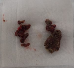 摘出された粉瘤(左被膜・右内容物）