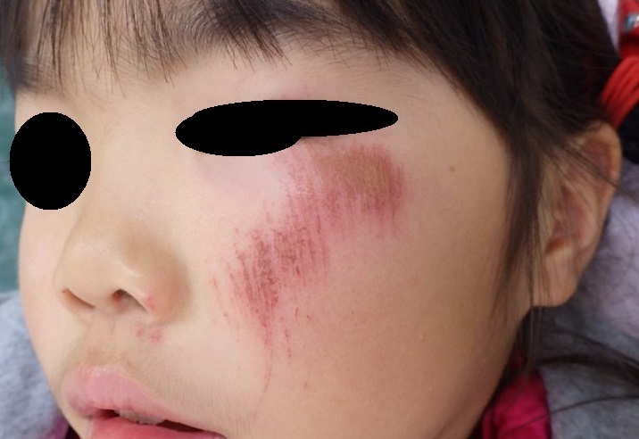 5歳 女児 顔の挫創です 湿潤療法 粉瘤 アテローム こおりたひろ整形形成外科クリニック 痛みの少ない粉瘤治療で多数の実績 大阪