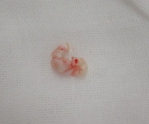 被膜ごと摘出された粉瘤