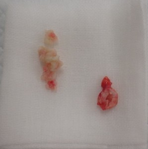 摘出された粉瘤(左内容物・右被膜)