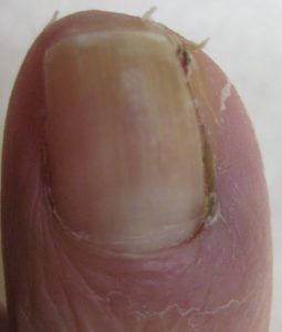 巻き爪（陥入爪）　術後1か月半