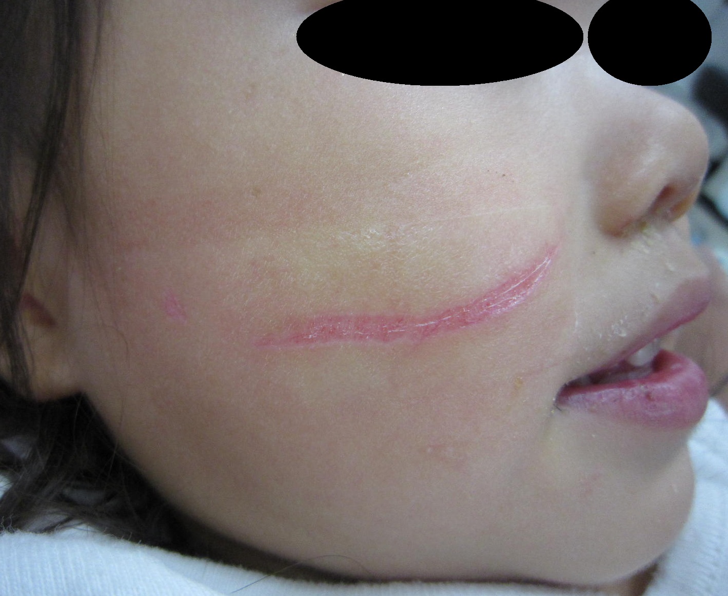 2歳 女児 顔の挫創です。(湿潤療法) - 粉瘤(アテローム) | こおりたひろ整形形成外科クリニック - 痛みの少ない粉瘤治療で多数の実績|大阪|