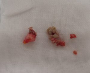 摘出された粉瘤(左被膜・右内容物)