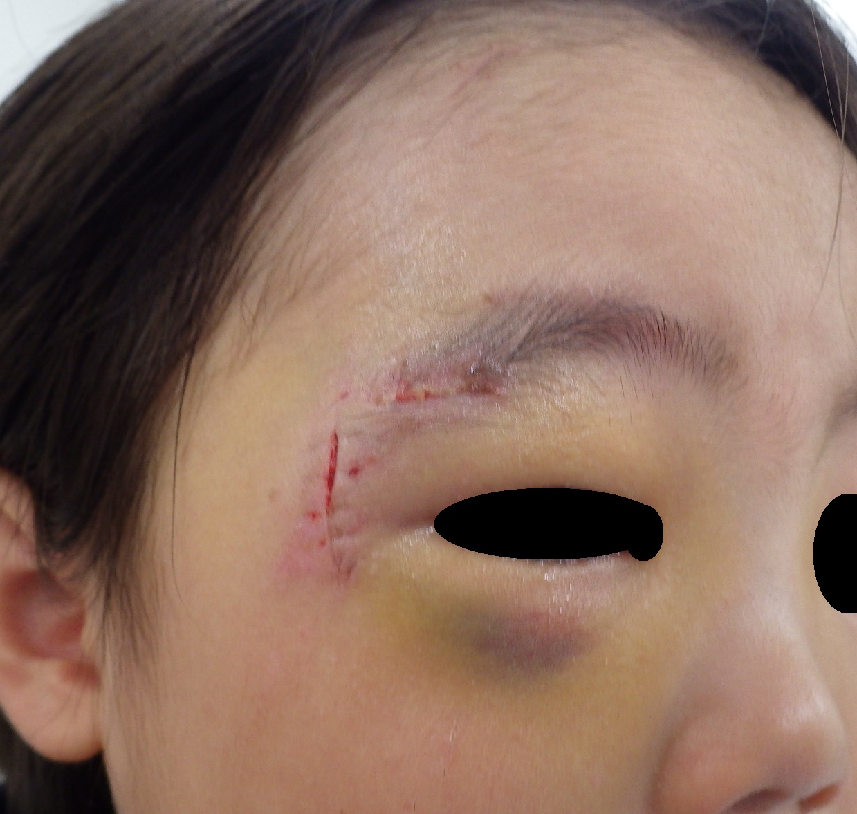2歳 顔の割創です テープ固定 大阪市 こおりたひろ整形形成外科クリニック 湿潤療法 粉瘤 アテローム くりぬき法