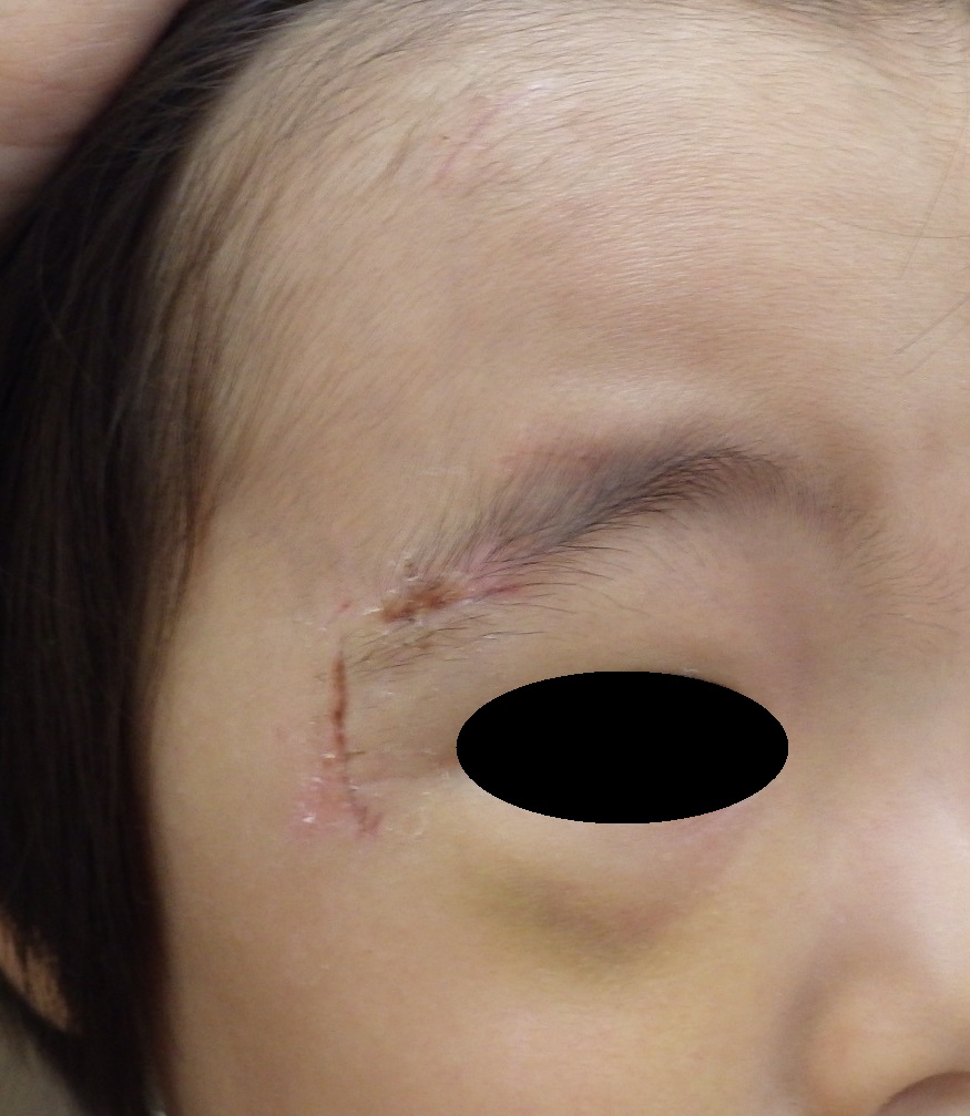 2歳 顔の割創です テープ固定 大阪市 こおりたひろ整形形成外科クリニック 湿潤療法 粉瘤 アテローム くりぬき法