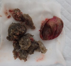 摘出された粉瘤(左内容物・右被膜)