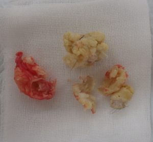 粉瘤(左被膜・右内容物)