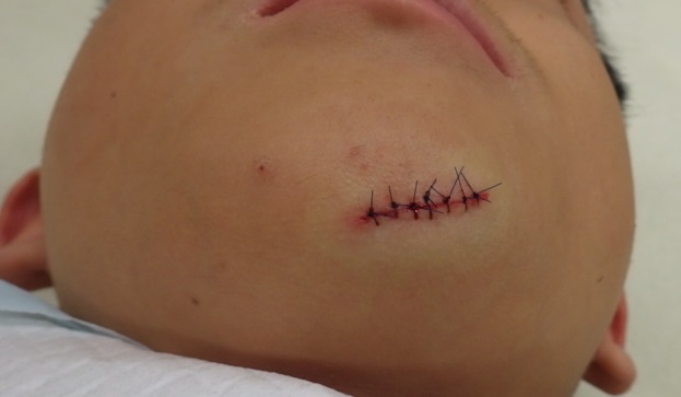 顎部の割創です 縫合 テープ固定 粉瘤 アテローム こおりたひろ整形形成外科クリニック 痛みの少ない粉瘤治療で多数の実績 大阪