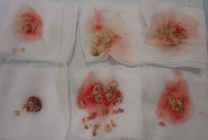 摘出された粉瘤（左下が被膜・その他は内容物）