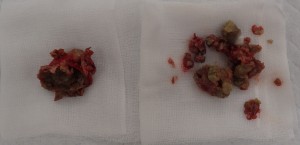 摘出された粉瘤(左・被膜、右・内容物)