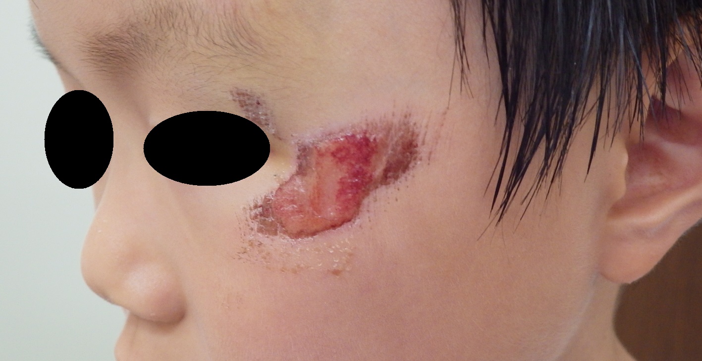 5歳 頬の挫創です 湿潤療法 大阪市 こおりたひろ整形形成外科クリニック 湿潤療法 粉瘤 アテローム くりぬき法