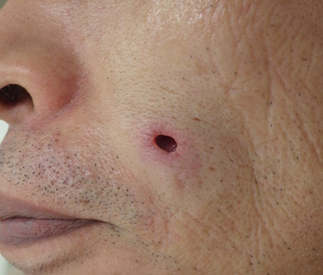 頬の粉瘤（アテローム）です。（くりぬき法） 粉瘤（アテローム） こおりたひろ整形形成外科クリニック 痛みの少ない粉瘤治療で多数の