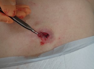 粉瘤（アテローム）摘出　術中(粉瘤被膜を摘出)