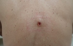 粉瘤（アテローム）摘出　術後5日