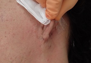 粉瘤（アテローム）摘出　術直後(耳側面)