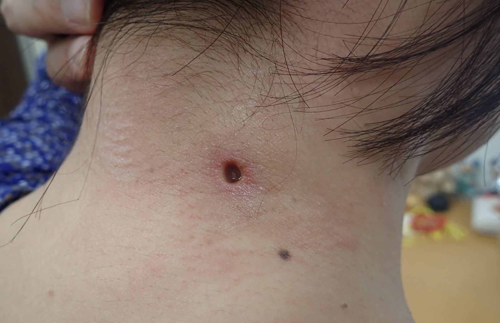 頚部の粉瘤（アテローム）です。（くりぬき法） 大阪市 こおりたひろ整形形成外科クリニック[湿潤療法/粉瘤/アテローム/くりぬき法]