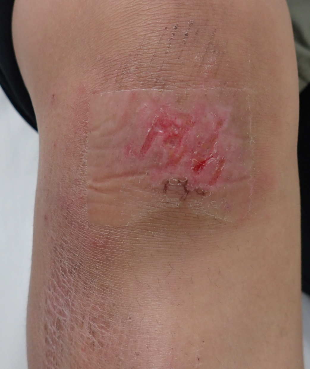 膝の挫創です 湿潤療法 大阪市 こおりたひろ整形形成外科クリニック 湿潤療法 粉瘤 アテローム くりぬき法