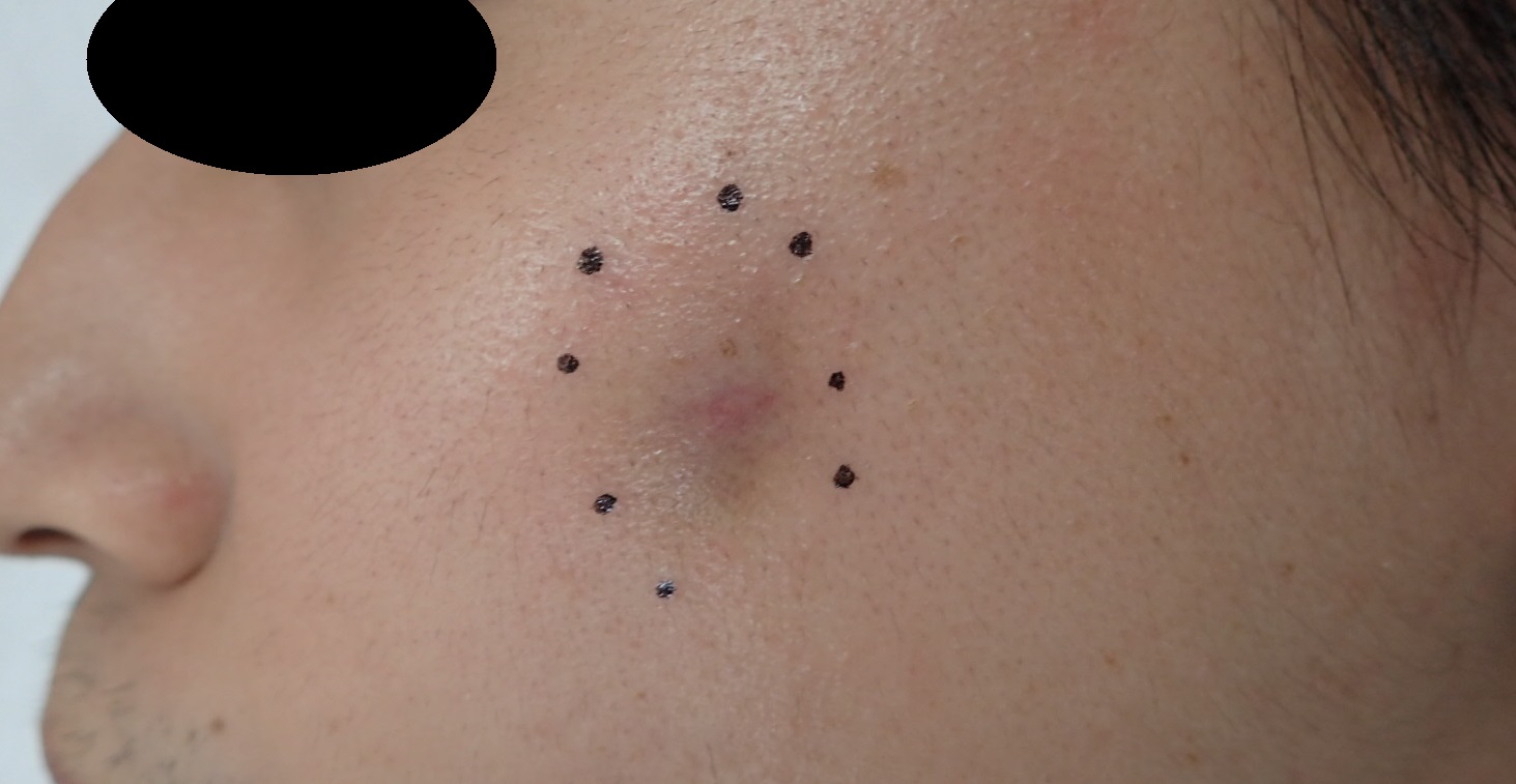 粉瘤 アテローム 頬 くりぬき法 粉瘤 アテローム こおりたひろ整形形成外科クリニック 痛みの少ない粉瘤治療で多数の実績 大阪