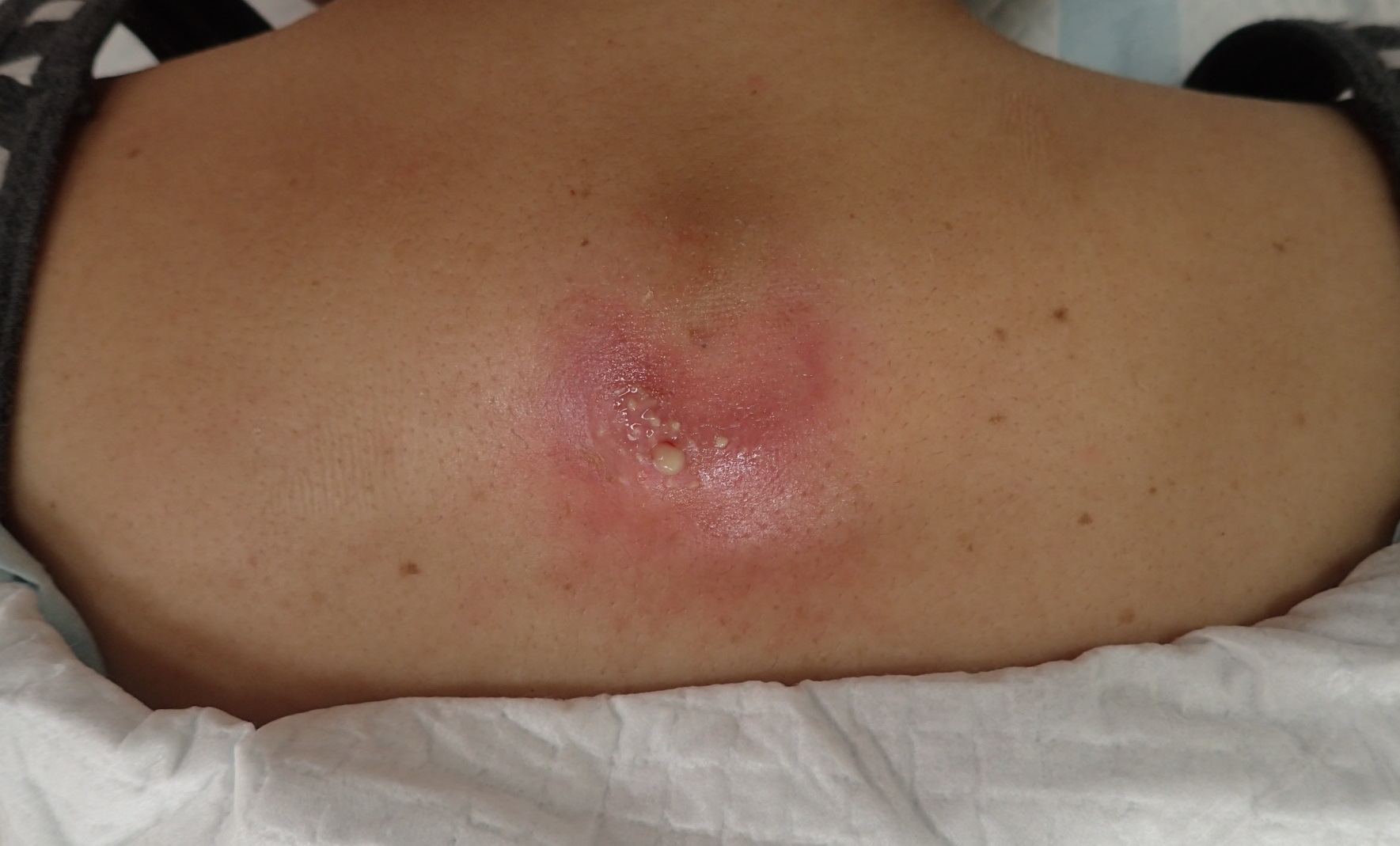 粉瘤（アテローム） | こおりたひろ整形形成外科クリニック - 痛みの少ない粉瘤治療で多数の実績｜大阪｜