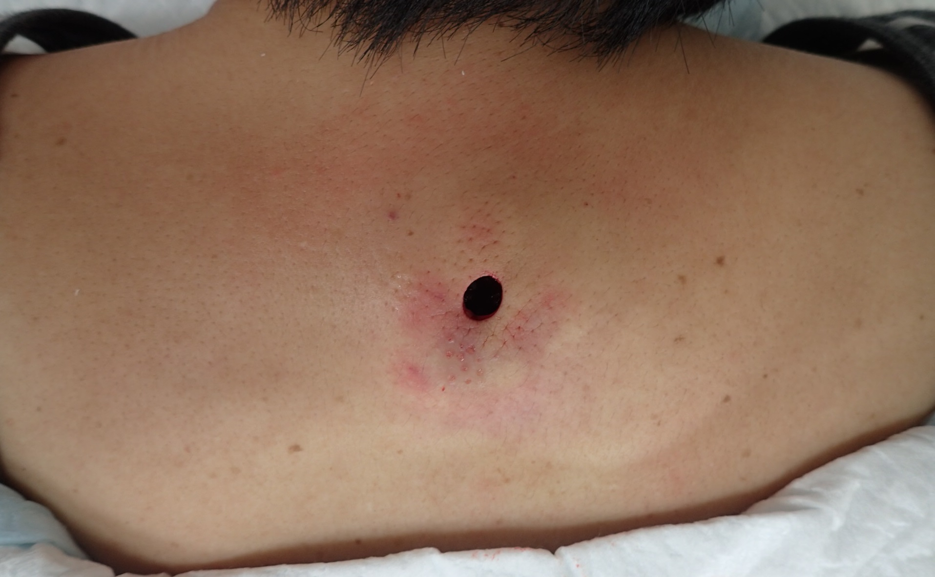 粉瘤（アテローム） | こおりたひろ整形形成外科クリニック - 痛みの少ない粉瘤治療で多数の実績｜大阪｜