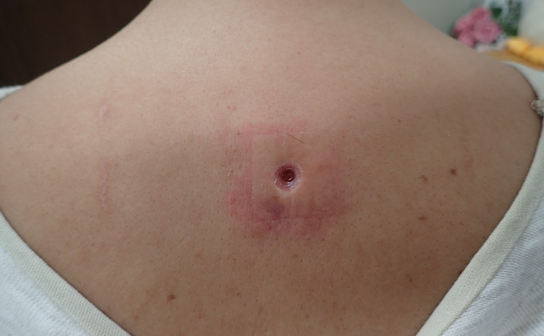 粉瘤（アテローム） | こおりたひろ整形形成外科クリニック - 痛みの少ない粉瘤治療で多数の実績｜大阪｜