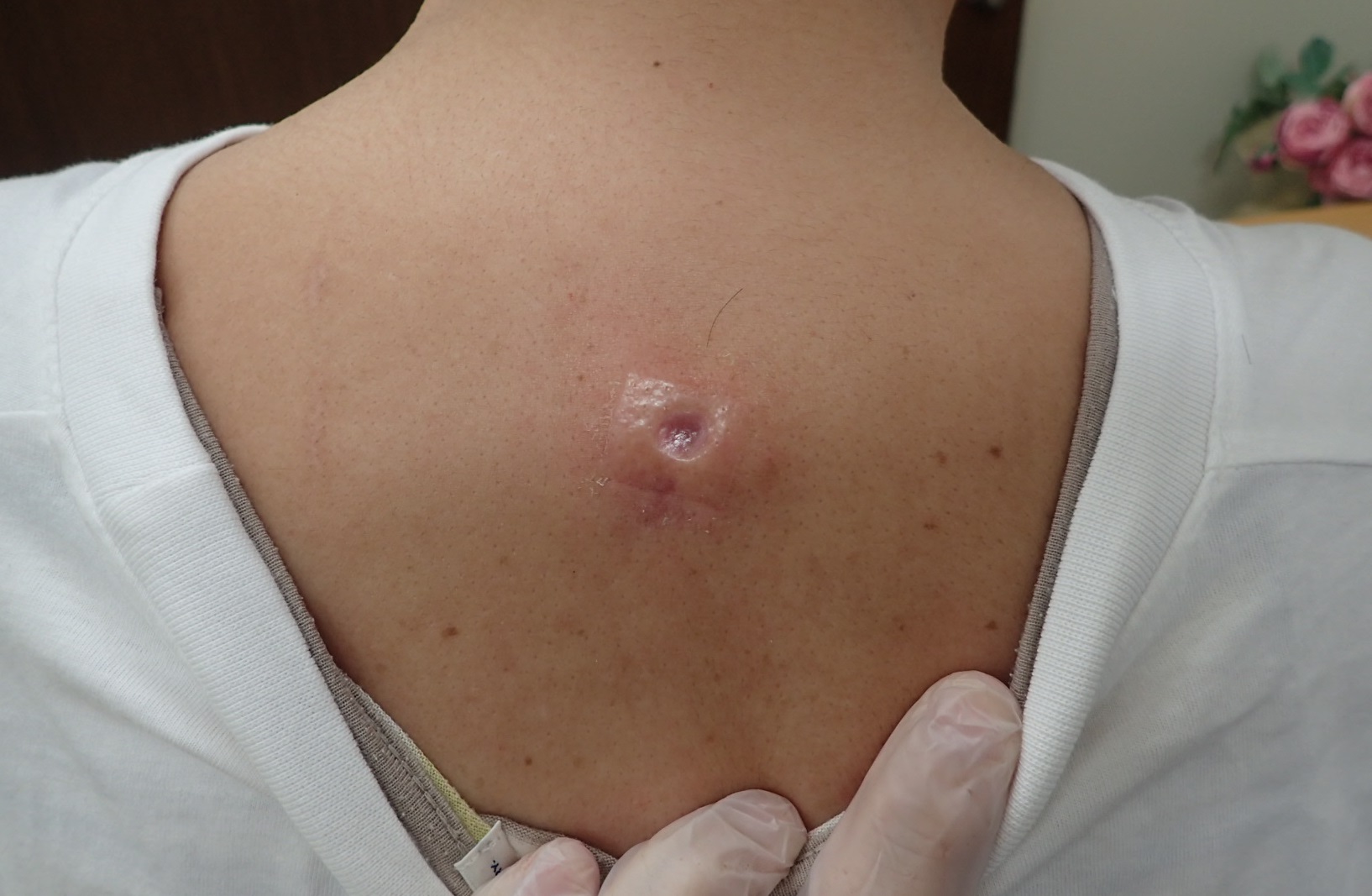 粉瘤（アテローム） | こおりたひろ整形形成外科クリニック - 痛みの少ない粉瘤治療で多数の実績｜大阪｜