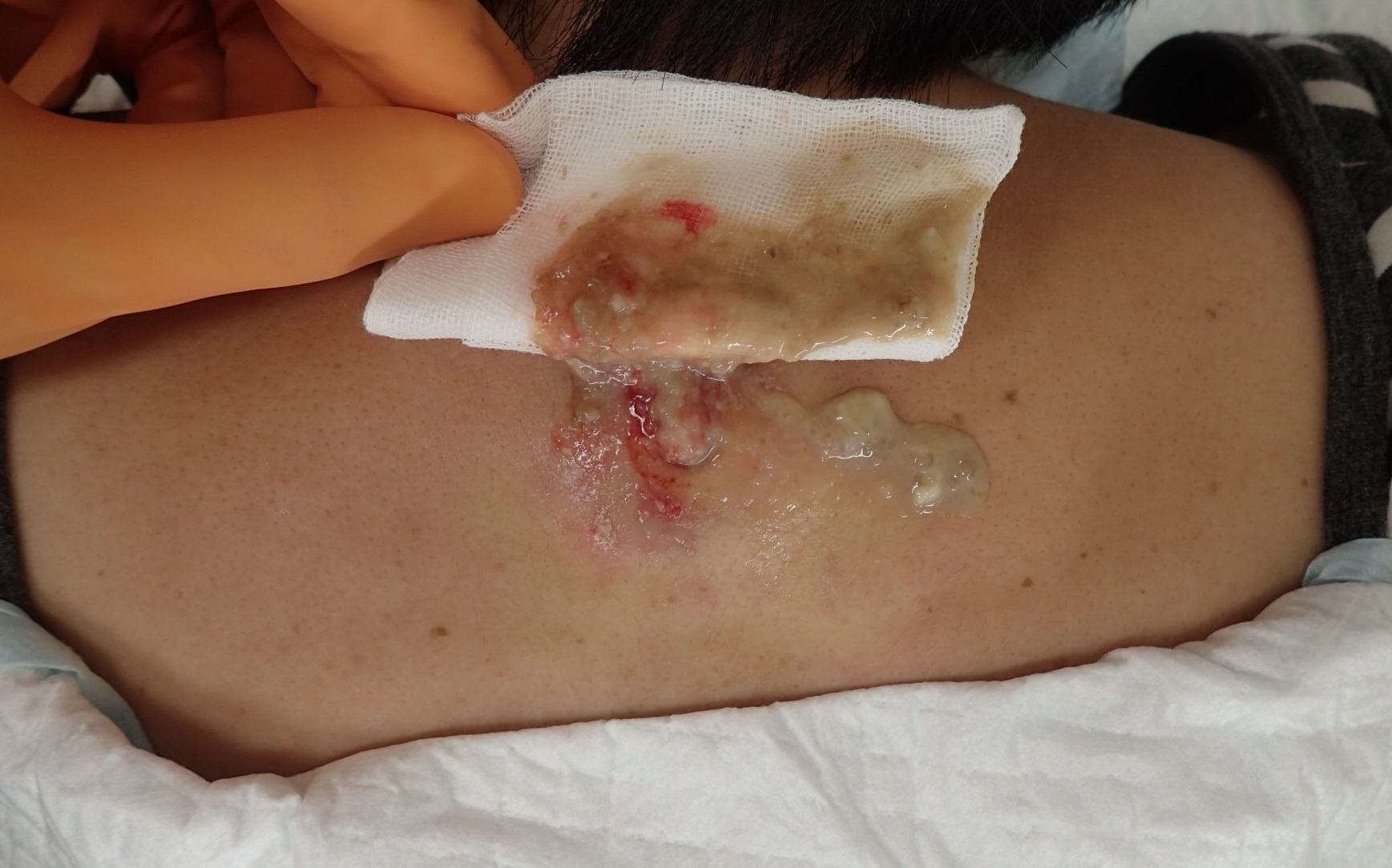 粉瘤（アテローム） | こおりたひろ整形形成外科クリニック - 痛みの少ない粉瘤治療で多数の実績｜大阪｜