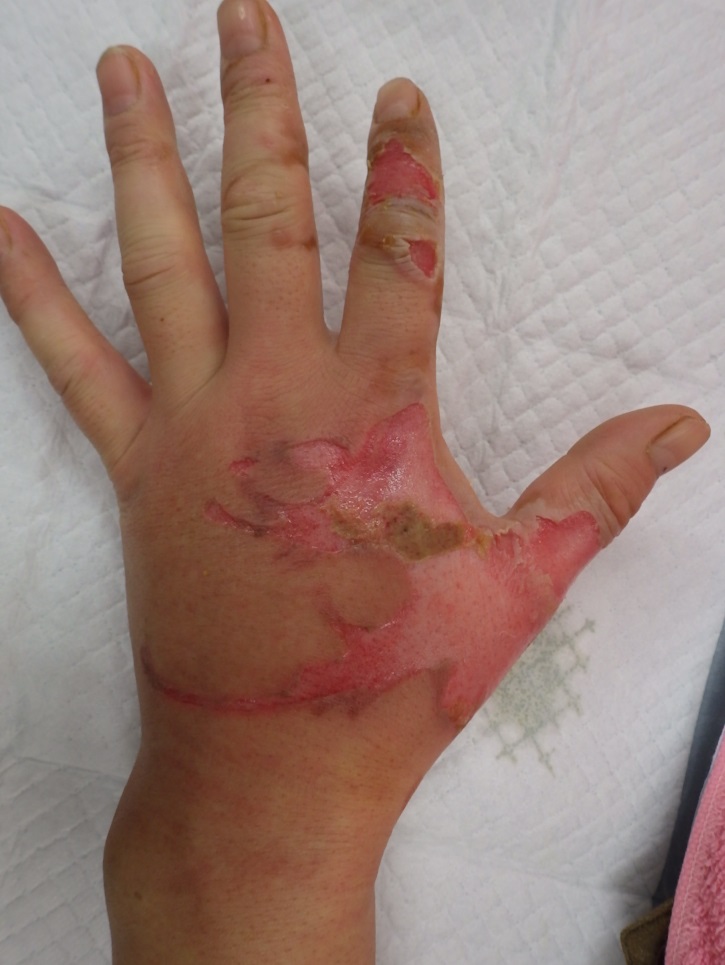 粉瘤（アテローム） | こおりたひろ整形形成外科クリニック - 痛みの少ない粉瘤治療で多数の実績｜大阪｜