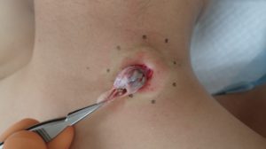 粉瘤（アテローム）摘出　術中(粉瘤被膜を摘出)　くりぬき法