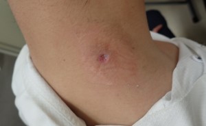 粉瘤（アテローム）摘出　術後11日　くりぬき法