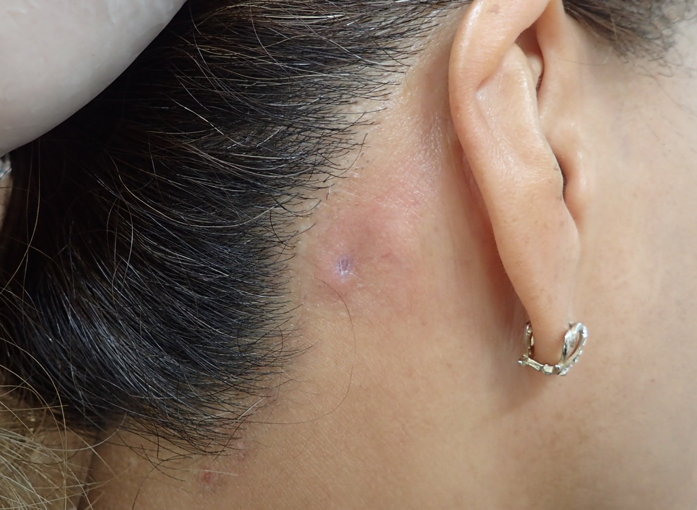 粉瘤（アテローム） | こおりたひろ整形形成外科クリニック - 痛みの少ない粉瘤治療で多数の実績｜大阪｜