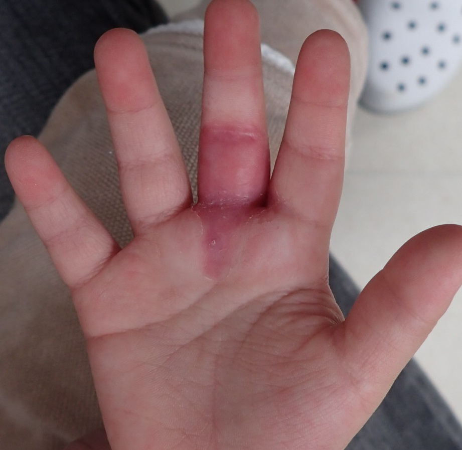 粉瘤（アテローム） | こおりたひろ整形形成外科クリニック - 痛みの少ない粉瘤治療で多数の実績｜大阪｜