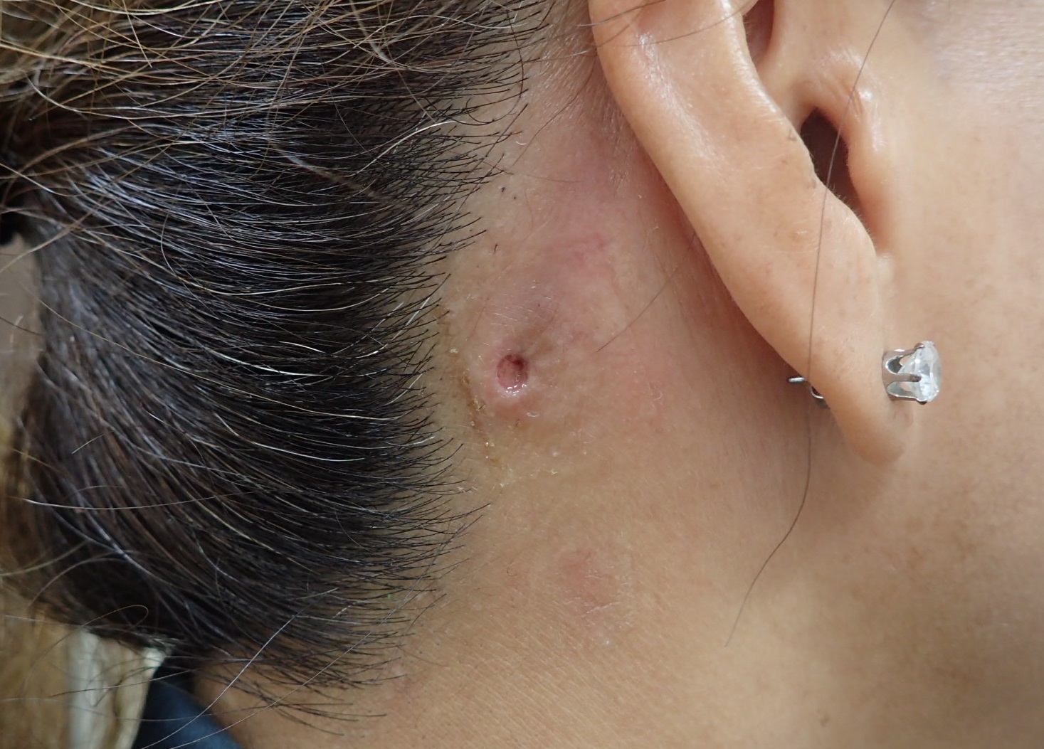 粉瘤（アテローム） | こおりたひろ整形形成外科クリニック - 痛みの少ない粉瘤治療で多数の実績｜大阪｜