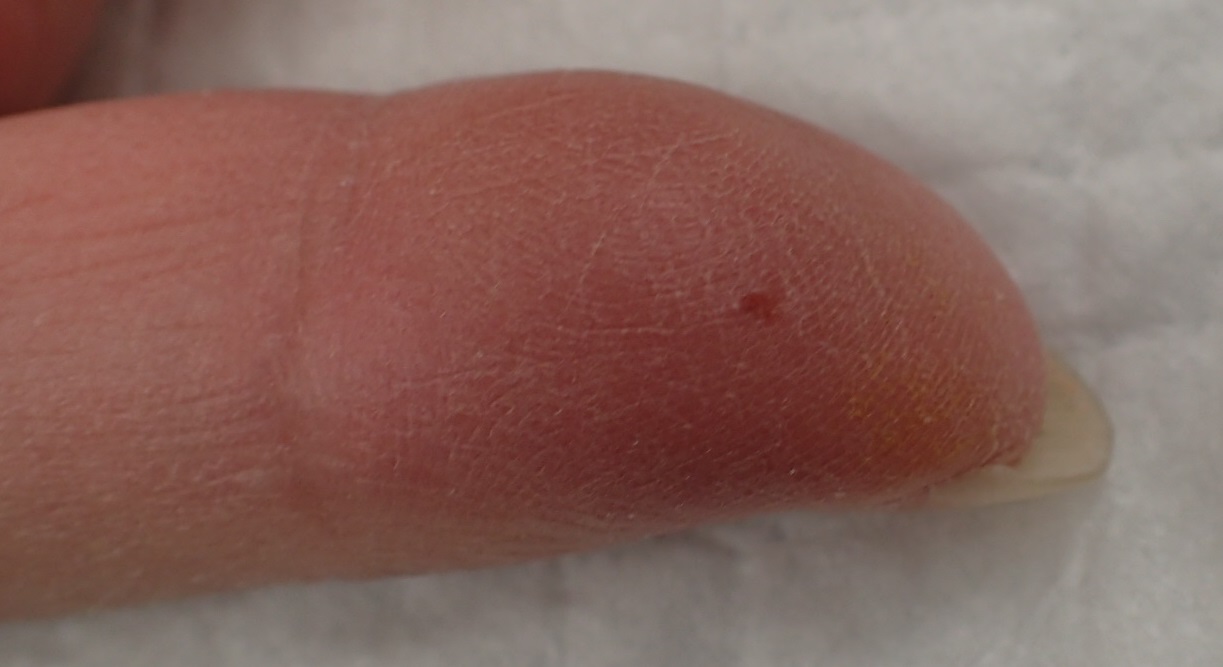 粉瘤（アテローム） | こおりたひろ整形形成外科クリニック - 痛みの少ない粉瘤治療で多数の実績｜大阪｜