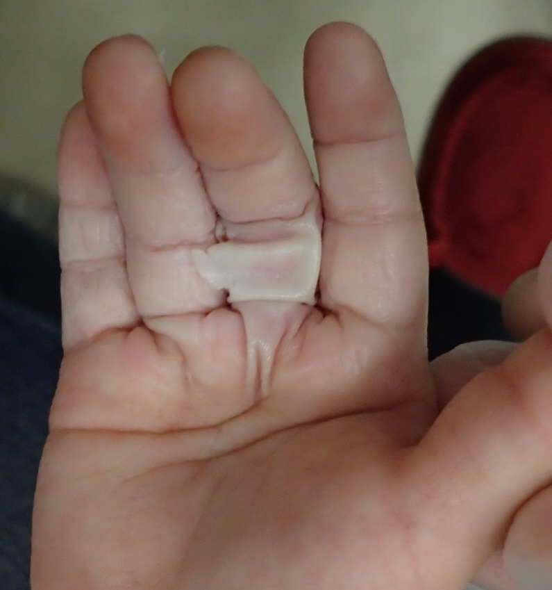 粉瘤（アテローム） | こおりたひろ整形形成外科クリニック - 痛みの少ない粉瘤治療で多数の実績｜大阪｜