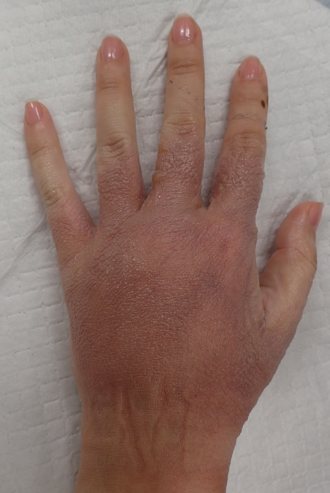 粉瘤（アテローム） | こおりたひろ整形形成外科クリニック - 痛みの少ない粉瘤治療で多数の実績｜大阪｜