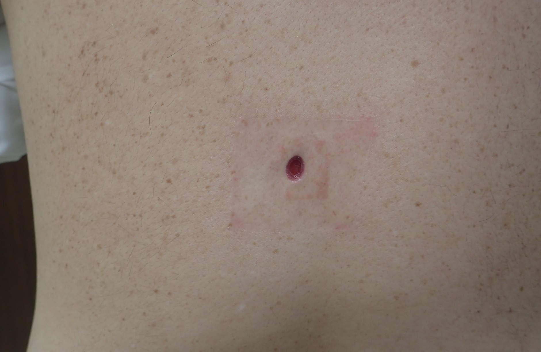 粉瘤（アテローム） | こおりたひろ整形形成外科クリニック - 痛みの少ない粉瘤治療で多数の実績｜大阪｜