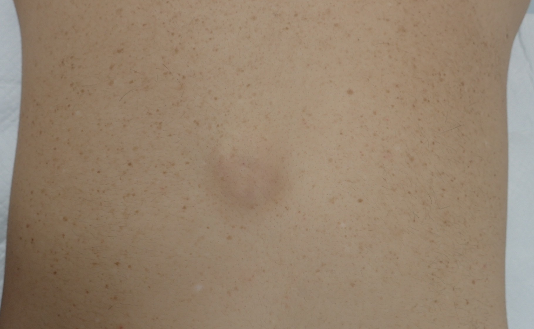 粉瘤（アテローム） | こおりたひろ整形形成外科クリニック - 痛みの少ない粉瘤治療で多数の実績｜大阪｜