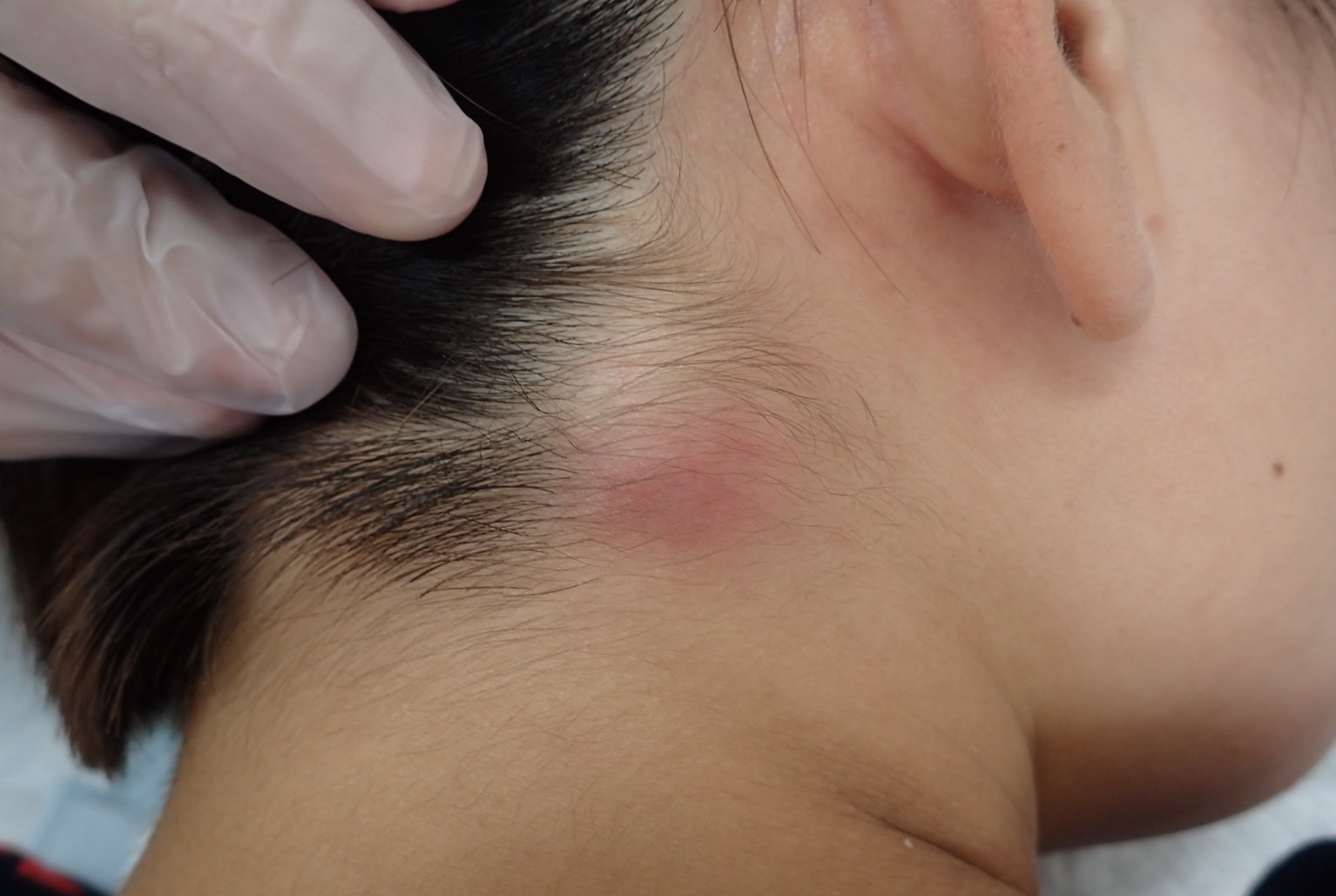 粉瘤（アテローム） | こおりたひろ整形形成外科クリニック - 痛みの少ない粉瘤治療で多数の実績｜大阪｜