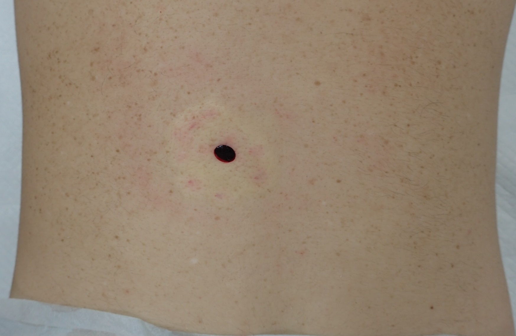 粉瘤（アテローム） | こおりたひろ整形形成外科クリニック - 痛みの少ない粉瘤治療で多数の実績｜大阪｜