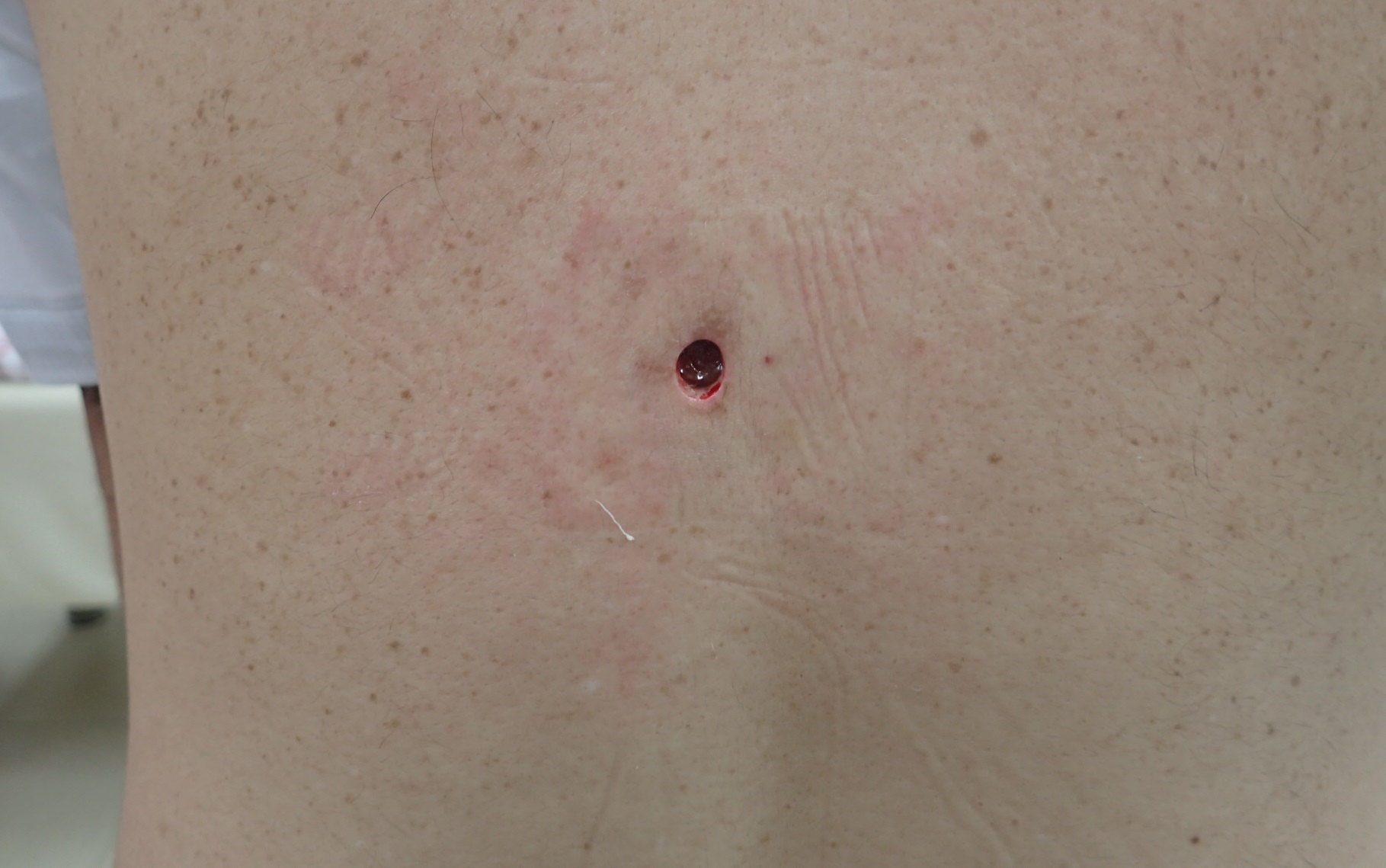 粉瘤（アテローム） | こおりたひろ整形形成外科クリニック - 痛みの少ない粉瘤治療で多数の実績｜大阪｜