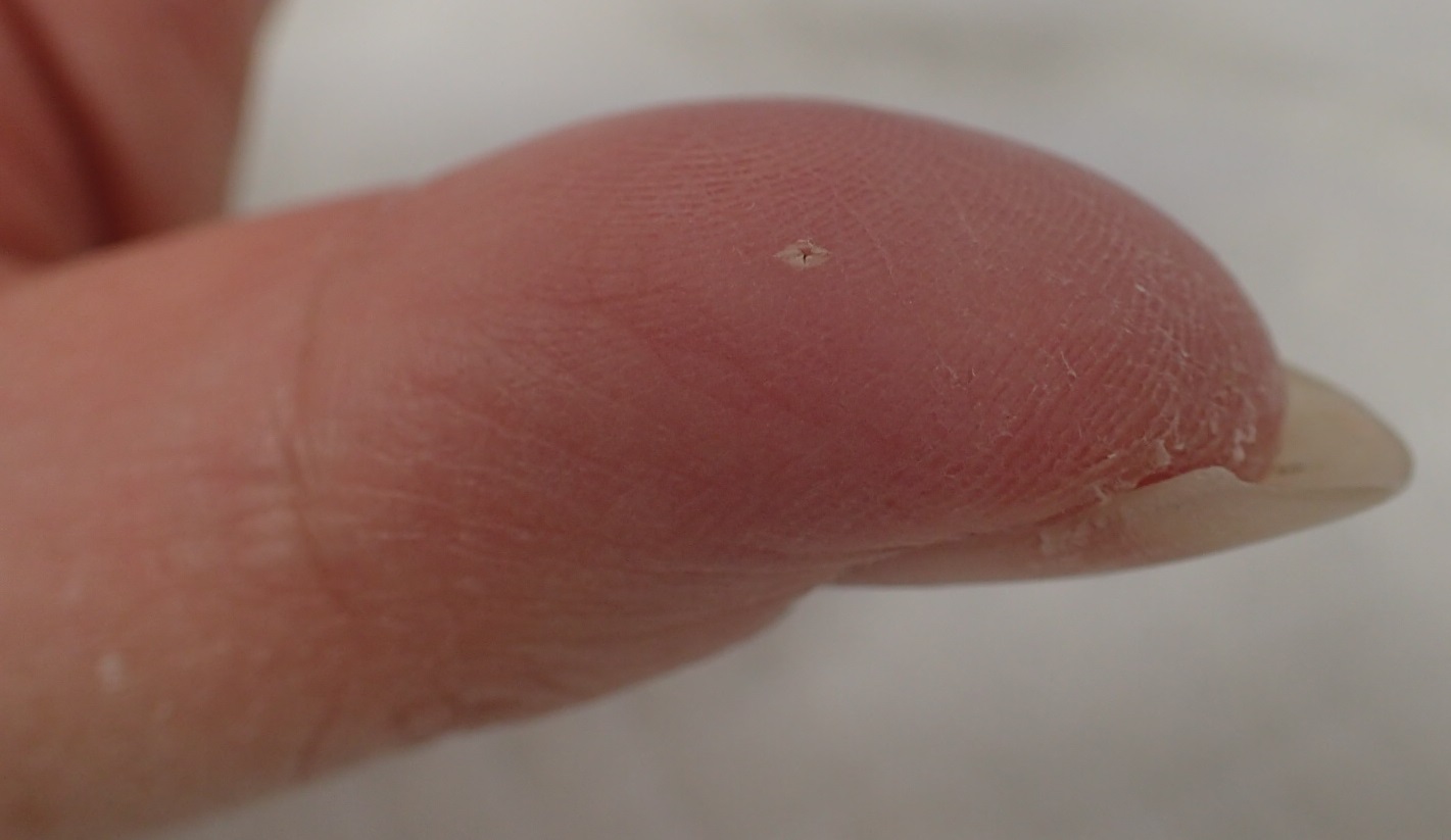 粉瘤（アテローム） | こおりたひろ整形形成外科クリニック - 痛みの少ない粉瘤治療で多数の実績｜大阪｜