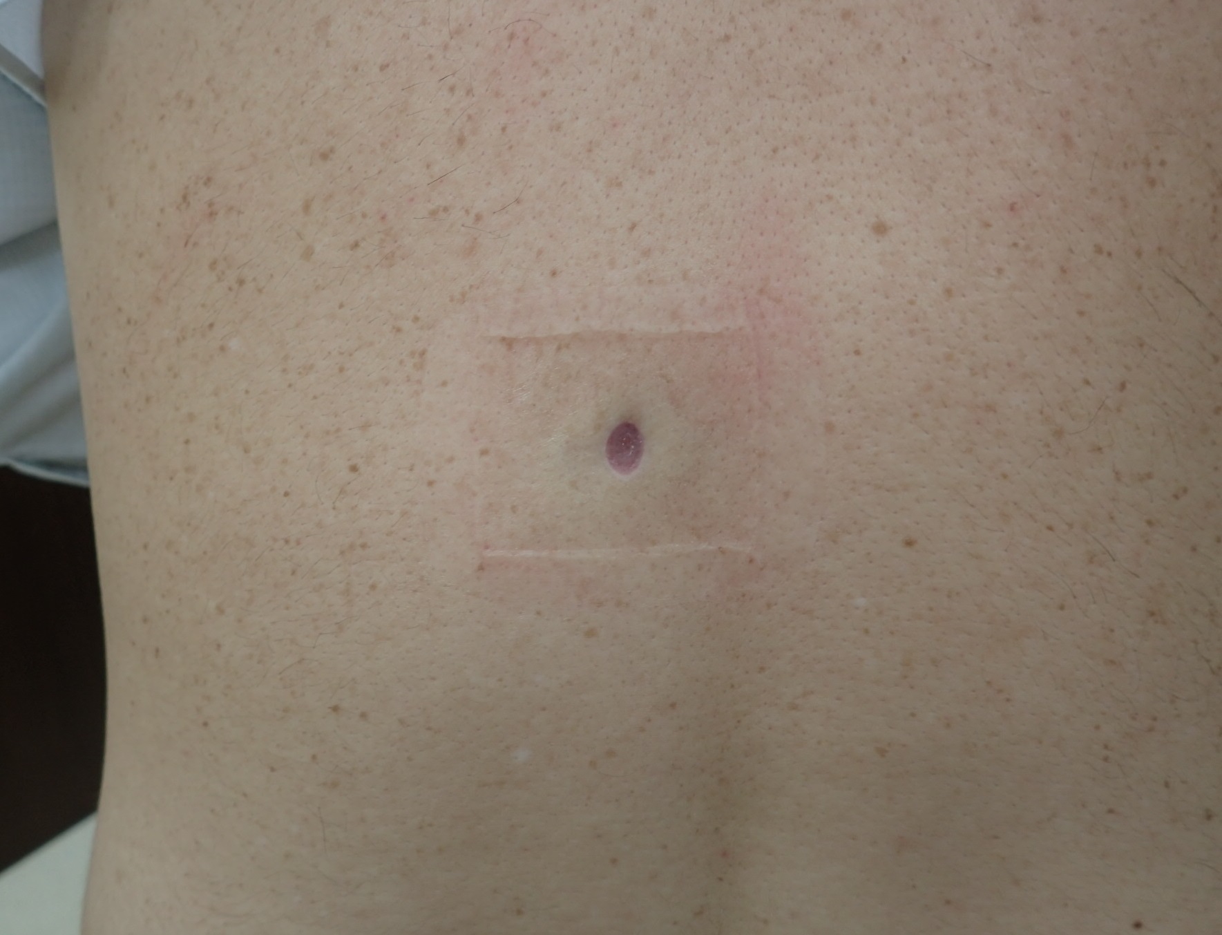 粉瘤（アテローム） | こおりたひろ整形形成外科クリニック - 痛みの少ない粉瘤治療で多数の実績｜大阪｜