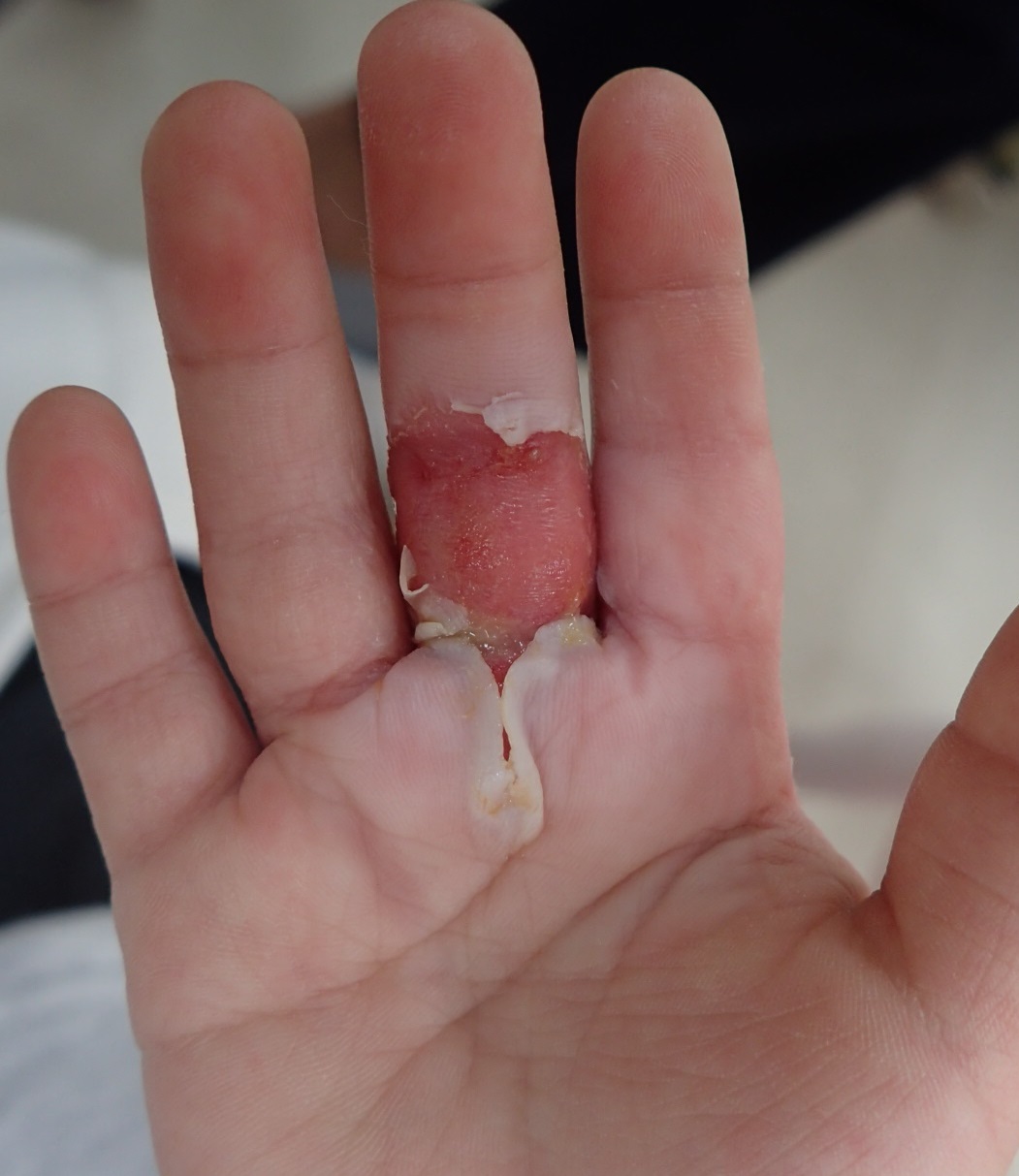 粉瘤（アテローム） | こおりたひろ整形形成外科クリニック - 痛みの少ない粉瘤治療で多数の実績｜大阪｜