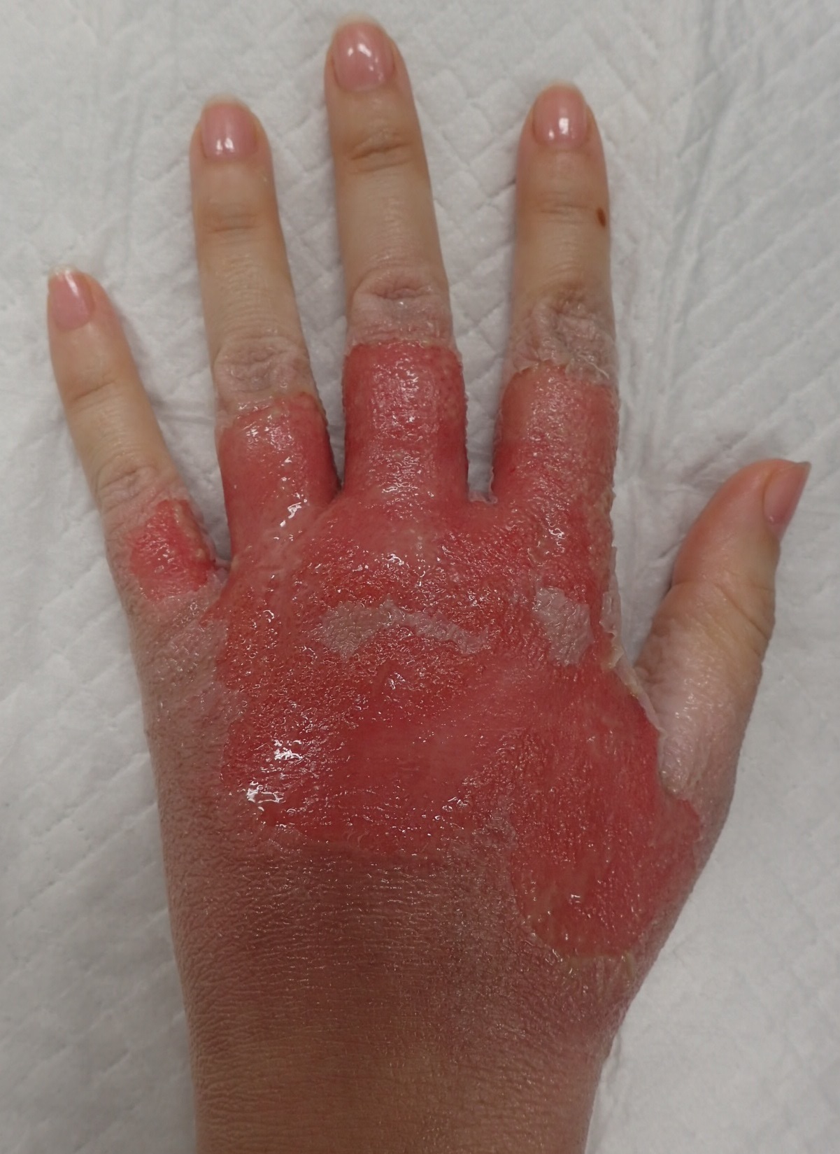 粉瘤（アテローム） | こおりたひろ整形形成外科クリニック - 痛みの少ない粉瘤治療で多数の実績｜大阪｜