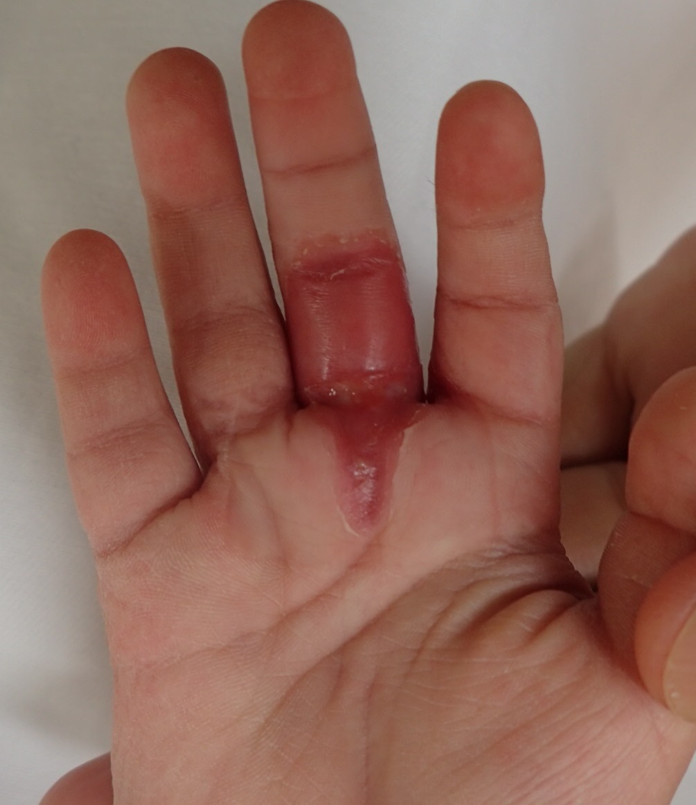 粉瘤（アテローム） | こおりたひろ整形形成外科クリニック - 痛みの少ない粉瘤治療で多数の実績｜大阪｜